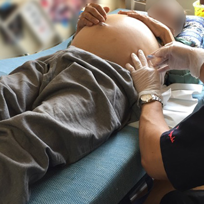 第34夜　がん性腹水の緩和について